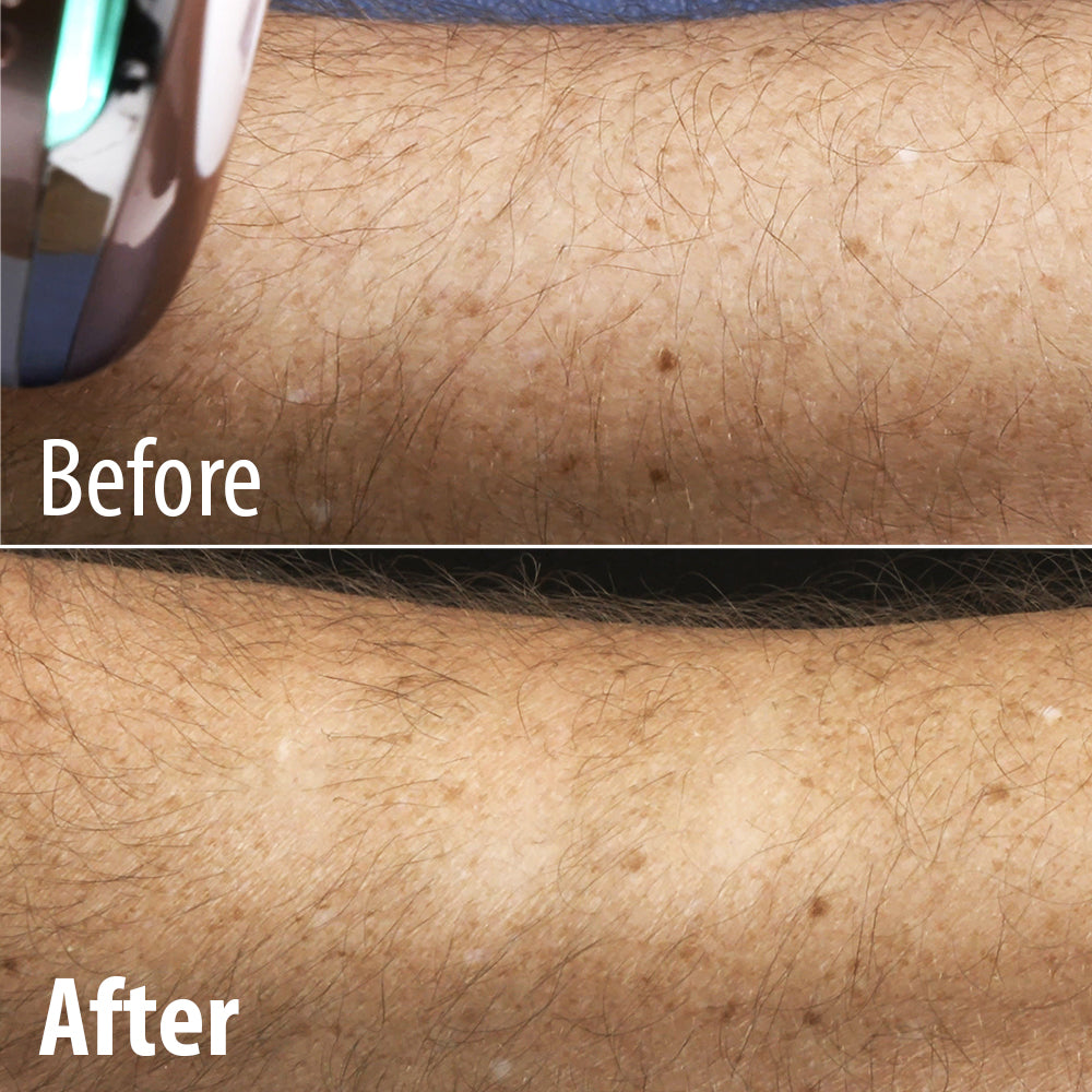 Arm Before and After