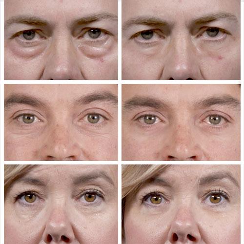 Thin Lizzy - Puffy Eye Remover Microcream - Before and After